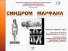 Синдром Марфана