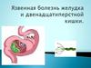 Язвенная болезнь желудка и двенадцатиперстной кишки