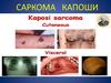 Саркома Капоши