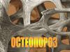 Остеопороз