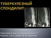 Туберкулезный спондилит