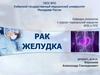 Рак желудка