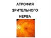 Атрофия зрительного нерва