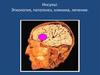 Инсульт. Этиология, патогенез, клиника, лечение