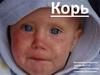 Детская инфекционная болезнь корь