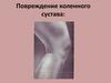 Повреждение коленного сустава