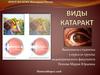 Виды катаракт