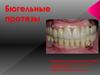 Бюгельные протезы
