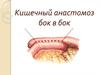 Кишечный анастомоз бок в бок