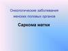 Онкологические заболевания женских половых органов. Саркома матки