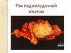 Рак поджелудочной железы