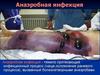 Анаэробная инфекция. Столбняк