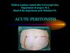Acute peritonitis